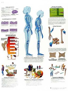 PLAGÁT OSTEOPORÓZA